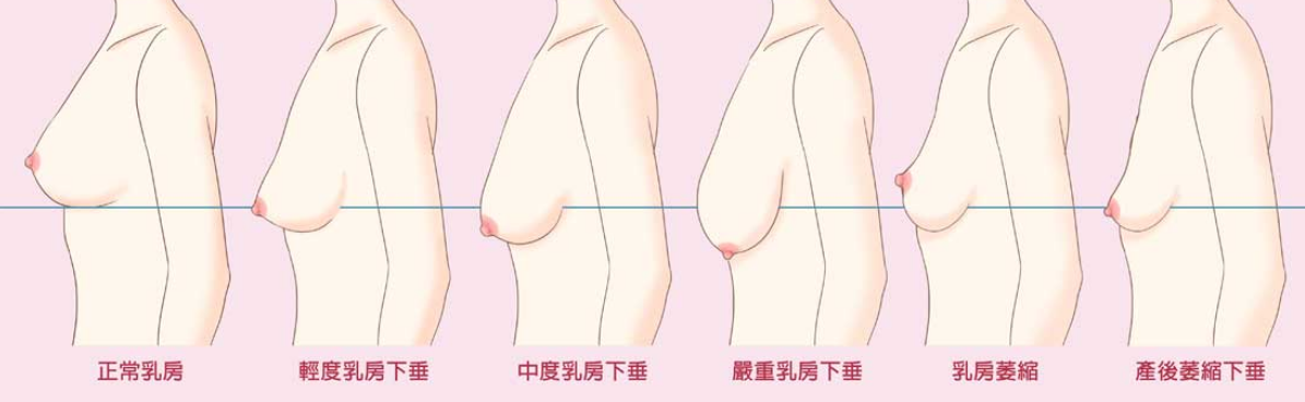 乳房发育不良？ 试试这些小妙招